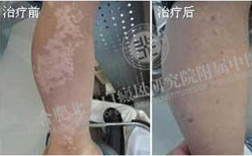 可怕的白癜風，差點讓我失去生命
