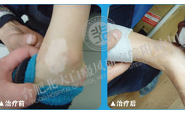 白癜風(fēng)，我終于徹底擺脫你