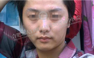 告別白癜風(fēng)，輕松面對高考